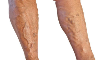 Tratamento das varices nas pernas.
