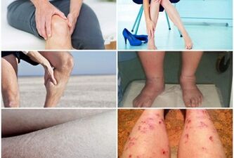 Síntomas de varices nas pernas