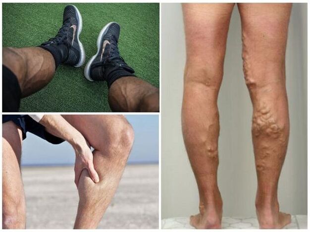 Como se ven as varices nas pernas dos homes