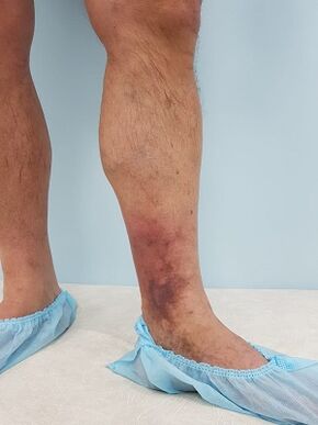 Complicacións das varices nos homes