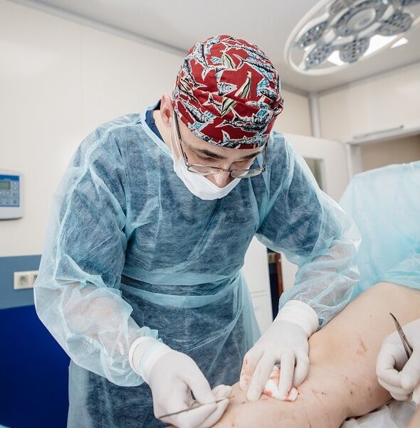 tratamento cirúrxico das varices