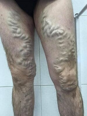 varices masculinas descoidadas