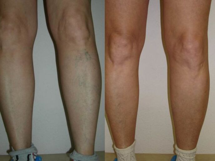 Pernas antes e despois do tratamento con láser de varices