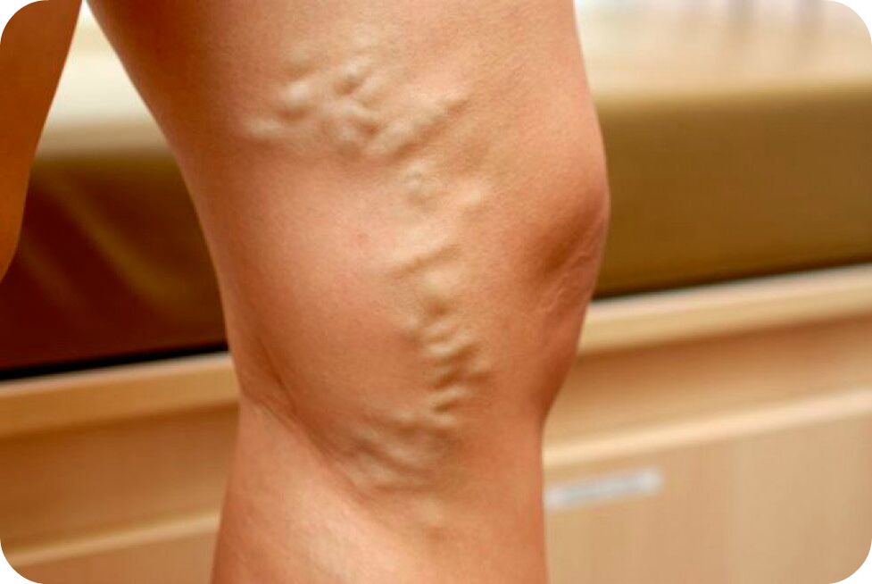 Varices das veas