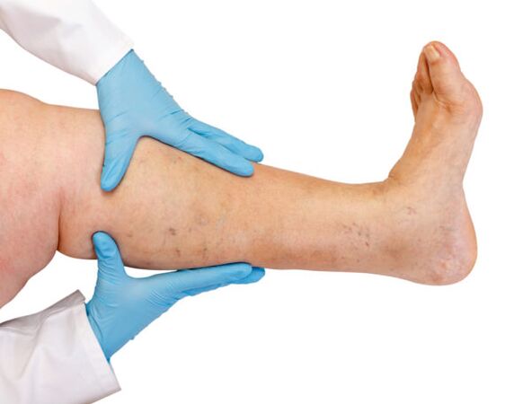 Varices nas pernas