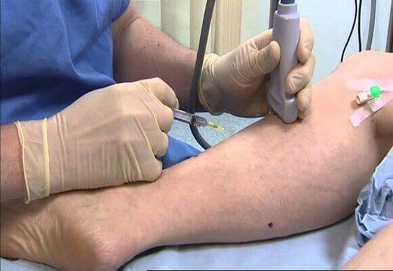 Tratamento de varices
