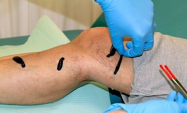 Hirudoterapia para varices