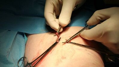 Flebectomía para varices