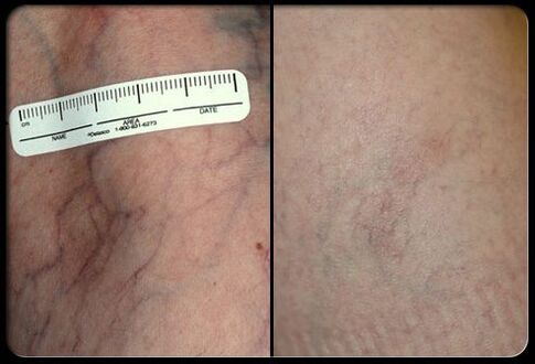 Antes e despois do procedemento de terapia con láser