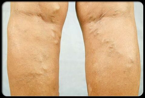 Varices nas pernas