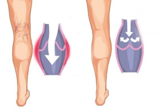 como son as varices