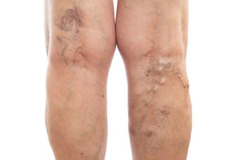 Varices das extremidades inferiores